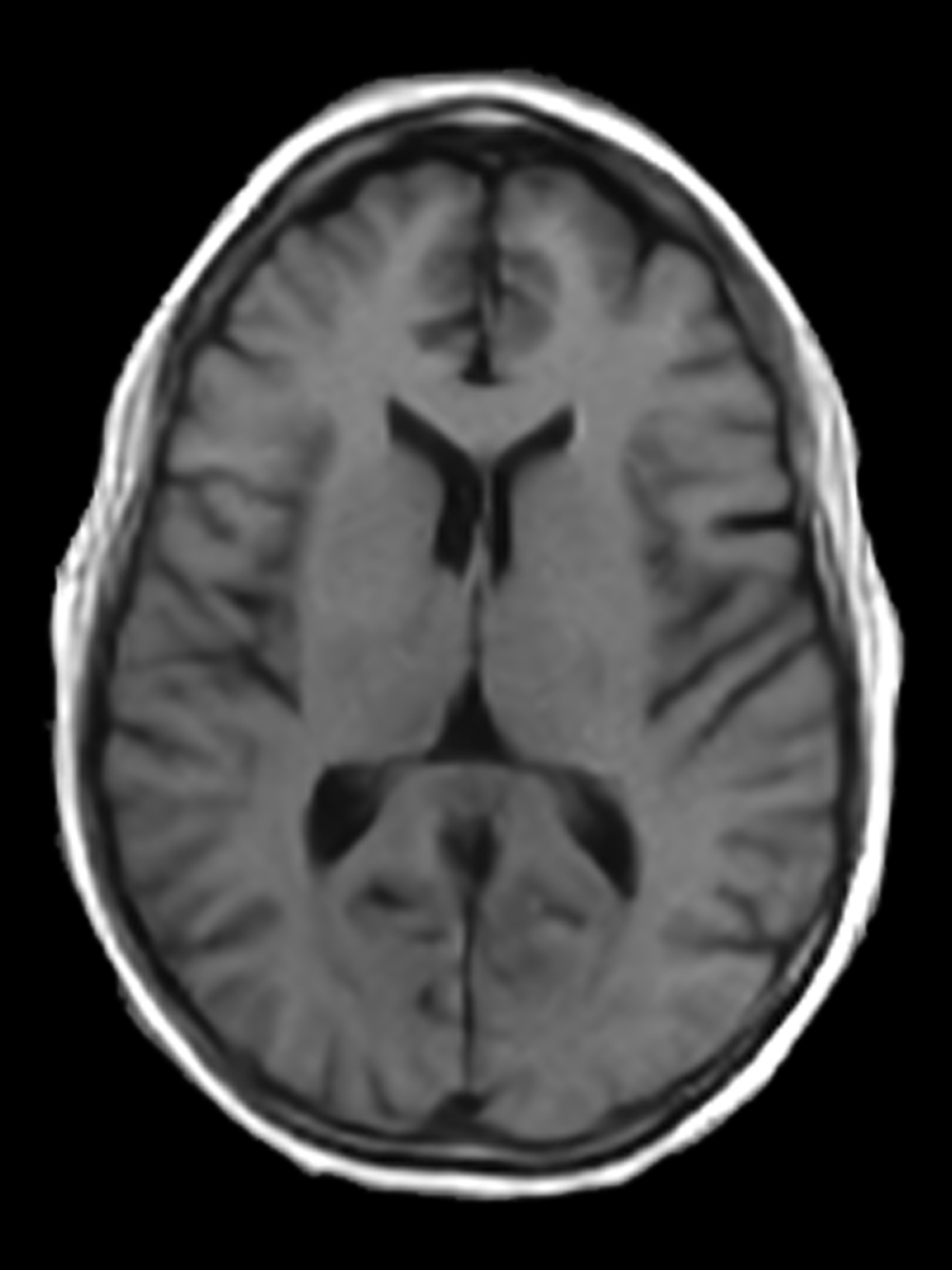 T1 (Gray/White)