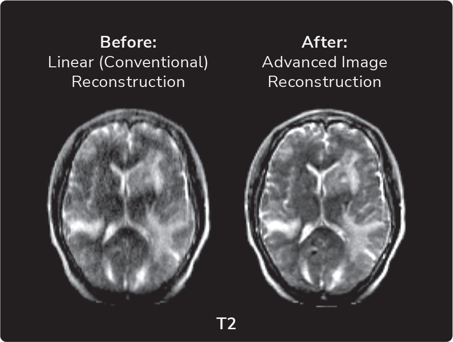 Advanced Image Reconstruction: Swoop® Portable MRI™