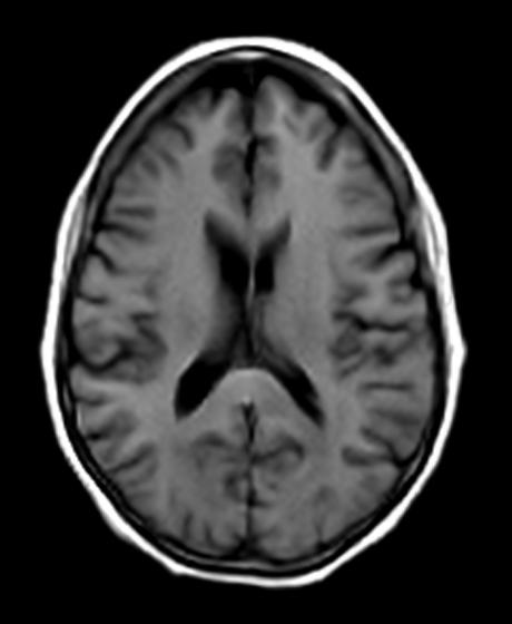 T1 (Gray/White)